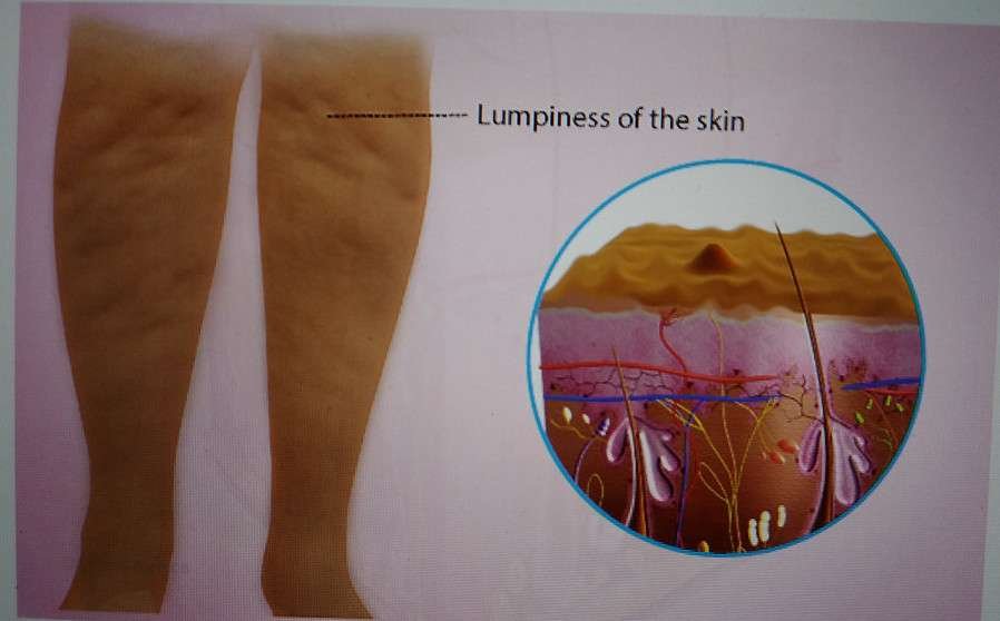 DIAGRAM OF LUMPY FATTY DEPOSITS ON THE LEGS THAT LOOKS LIKE COTTAGE CHEESE