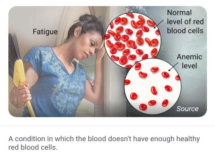AMEMIA - LADY HAS WEAKNESS DUE TOMLOW COUNT OF RED BLOOD CELLS