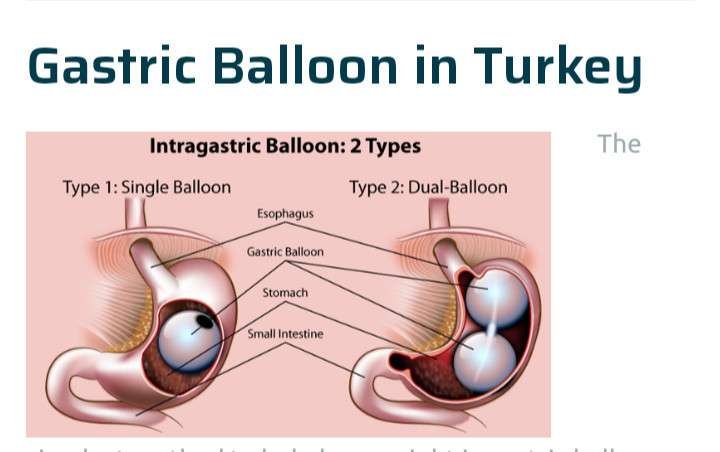 GASTRIC BALLOON INSERTED INTO TUMMY