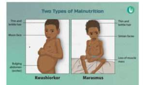 DIAGRAM DEPICTS TWO CHILDREN - ON THE LEFT CHILD HAS SWOLLEN BELLY. ON THE RIGHT CHILD IS WAY UNDERWEIGHT