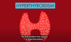 ILLUSTRATION OF HYPERTHYROIDISM SHOWS A PINK BUTTERFY SHAPED THYROID WITH RED BACKGROUND. IT HAS THE TITLE IN LIGHT HYPERTHYROIDISM IN BLIE