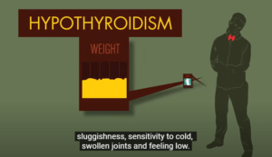 ILLUSTRATION OF HYPOTHYRODISM