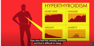 ILLUSTRATION OF  HYPERTHYROIDISM