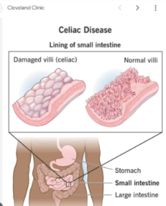 DIAGRAM OF CELIAC DISEASE. NORMAL VILLI (CELIAC) ON THE LEFT. INFLAMMED VILLI ON THE RIGHT