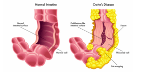 DIAGRAM OF CJRON'S DISEASE, A NORMAL INTESTINE ON THE LEFT, CHROHM'S DISEASE ON THE RIGHT WITH THE INFLAMATION SHOWN IN YELLOW CLUSTERS 