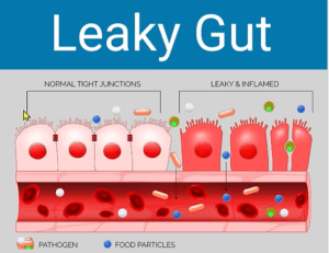 DIAGRAM OF A LEAKY GUT IN WHITE LETTERS WITH BLUE BACKGROUND AT TOP AND A HEALTHY GUT ON THE LEFT SIDE IN PINK AND UNHEALTHY GUT IN RED ON THE RIGHT SIDE UNDERNEATH.