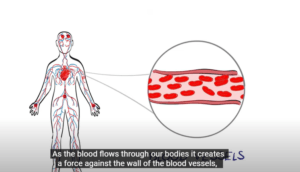 REDUCING HIGH BLOOD PRESSURE IS LIFE SAVING